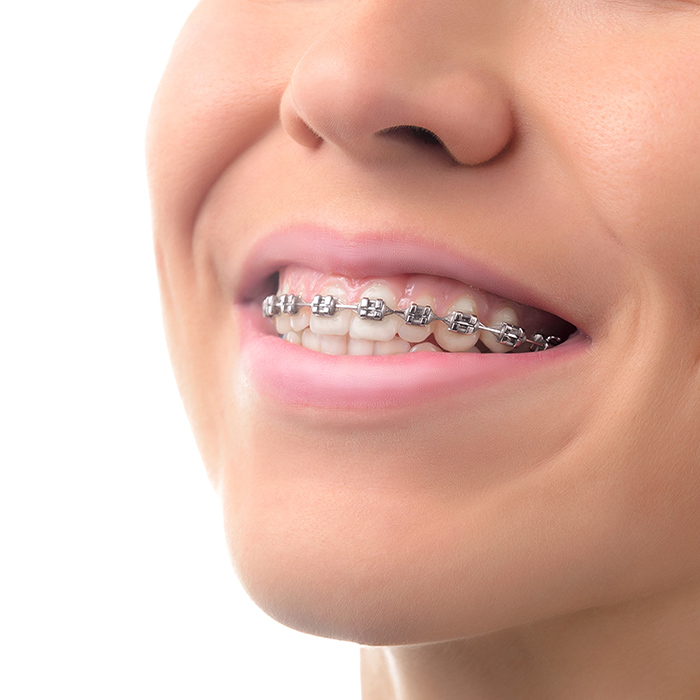 The benefits of orthodontic treatment include a healthier mouth, a more pleasing appearance, and teeth that are more likely to last a lifetime.