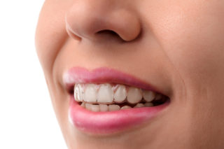 A great alternative to traditional wire and bracket braces. A series of clear Invisalign® aligners are custom fabricated from a smooth, comfortable plastic material that is created especially for a patient’s teeth.