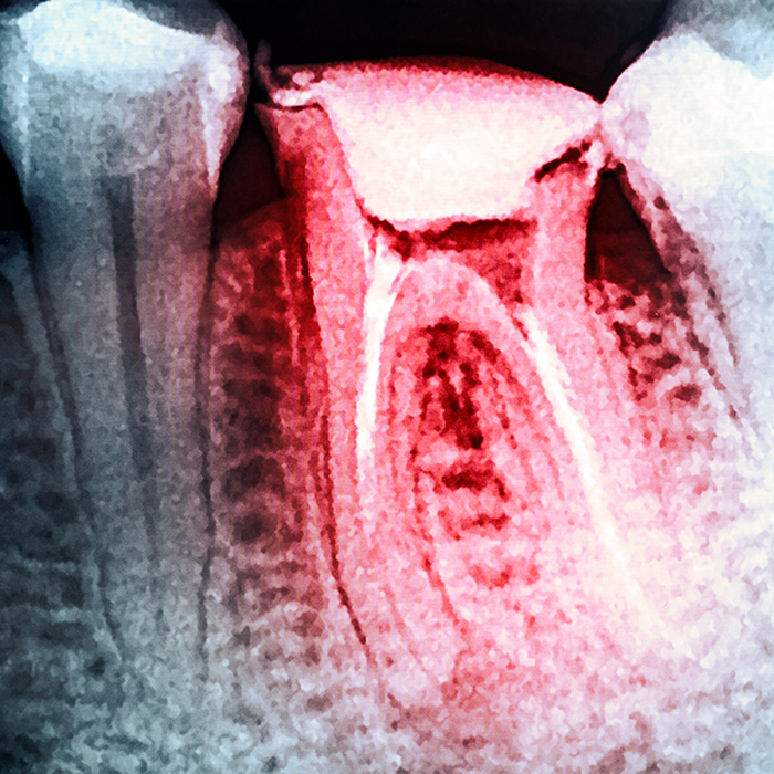 Root canal treatment in Sudbury, Ontario